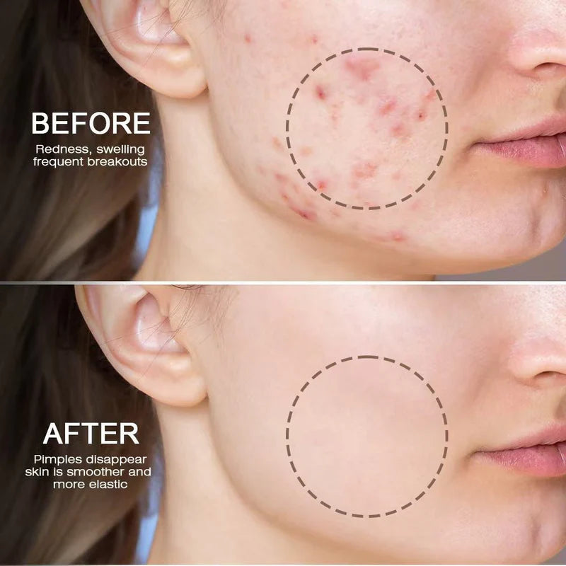 Snmifun - Bee Anti-Acne Gel